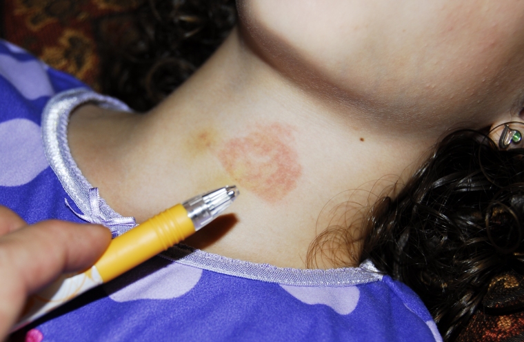 This is the burn the cold spray that was supposed to numb her left on her neck in Nov. 2011.