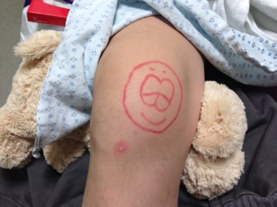 The knee with the AVM